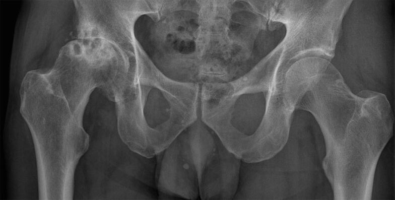 Röntgende kalça ekleminin 3. evre artrozu