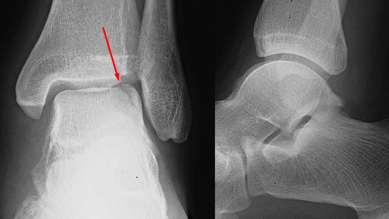 ayak bileği röntgeni