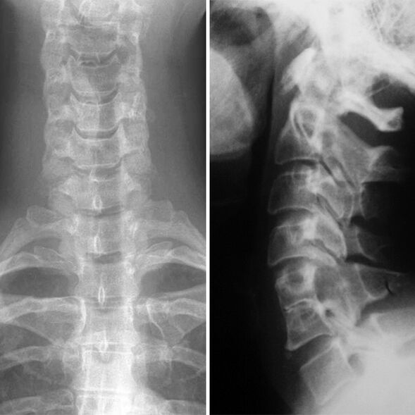 X -Ray servikal omurga