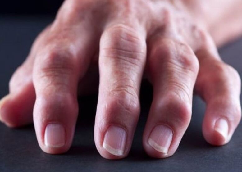 parmak eklemlerinde ağrı nedeni olarak romatoid artrit