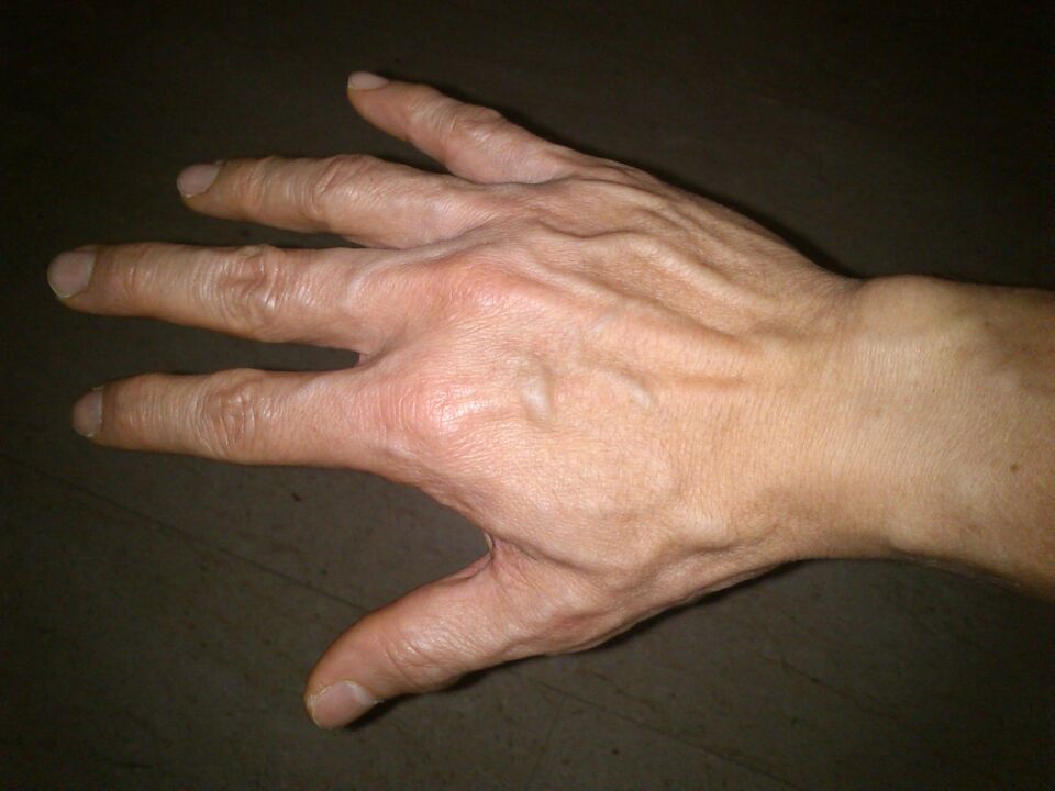 parmakların eklemlerinde kemiklerin deformasyonu ve ağrı