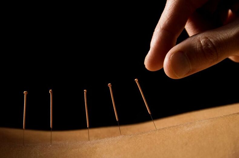 sırt ağrısı için akupunktur